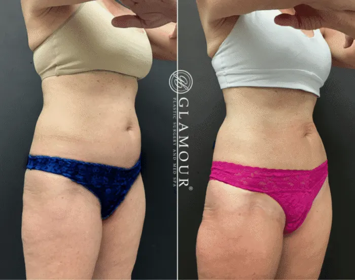 Emsculpt NEO & Emtone: Sculpted, Smooth Results