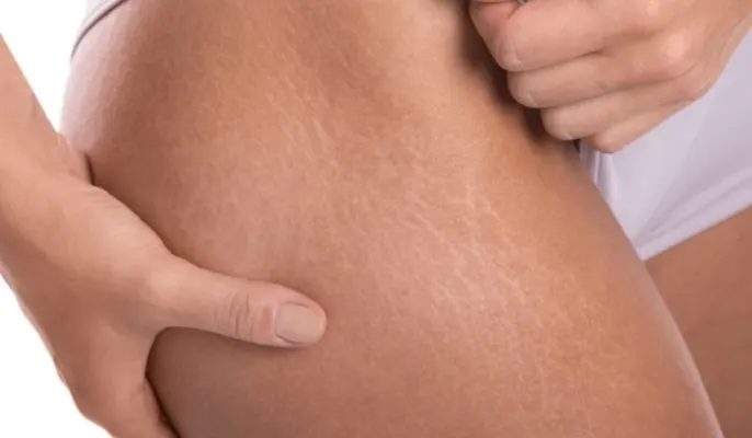 Stretch Mark Treatments: Top Options