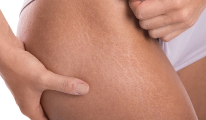 Stretch Mark Treatments: Top Options