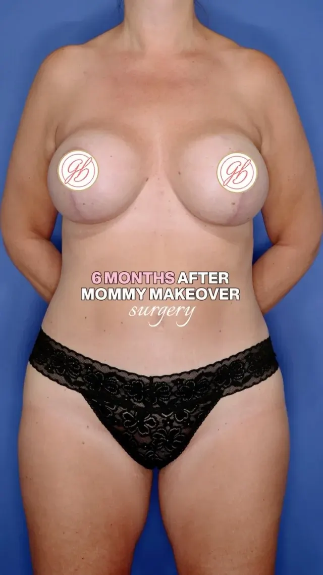 Tummy Tuck vs Non-Surgical Treatments treatment at Glamour Plastic Surgery and Med Spa, Houston, TX