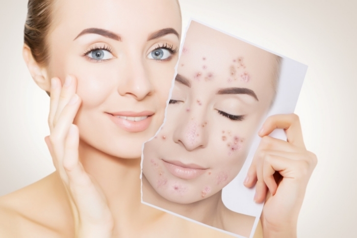 Tixel Skin Treatments with Regenerative Topicals