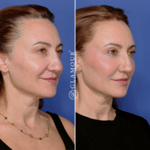 Eyelid lift results with Dr. Olga Bachilo in Houston, 2 weeks post-op