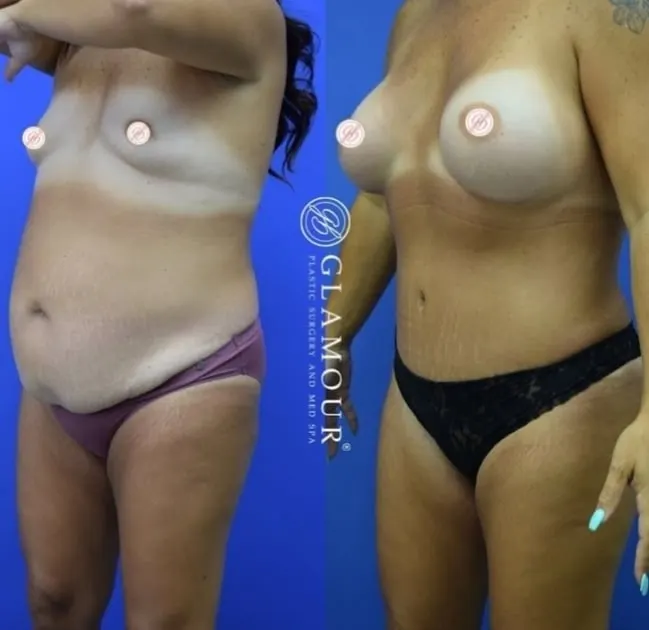 Mommy Makeover: What to Know Before Surgery