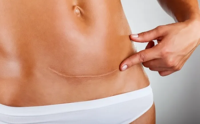 Scar Management After Surgery: Silicone Gel & Treatments