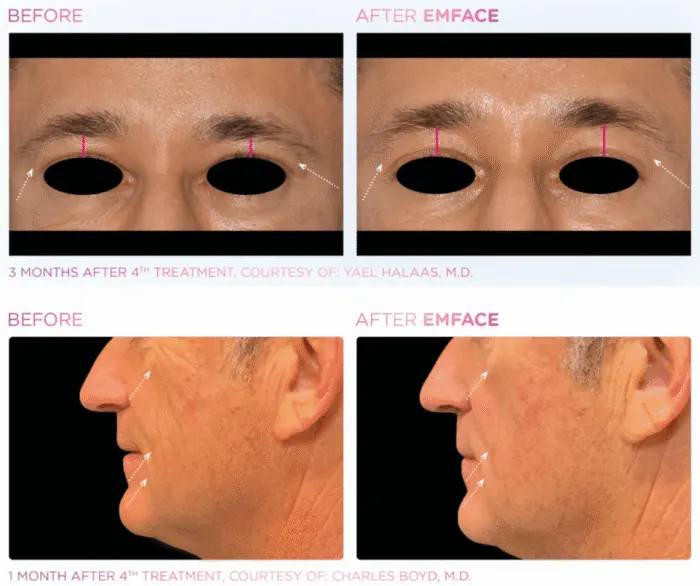 Emface Facial Rejuvenation: Lift Without Needles