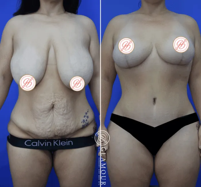 Mommy Makeover: Before, During & After Surgery