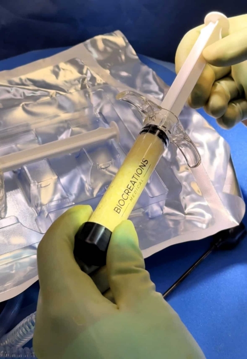 AlloClae Fat Grafting: Restore Lost Volume