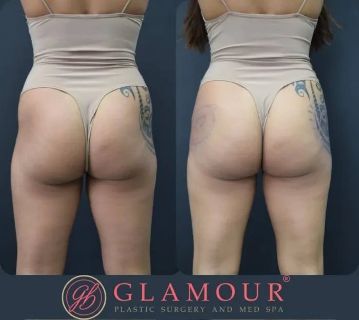 Non-Surgical Butt Enhancement Options