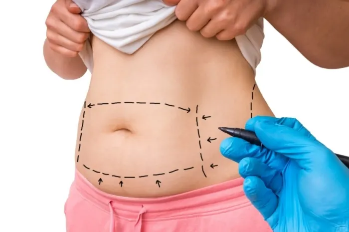 Full vs Mini Tummy Tuck: Which Is Right for You?