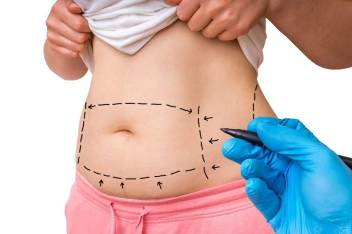 Full vs Mini Tummy Tuck: Which Is Right for You?