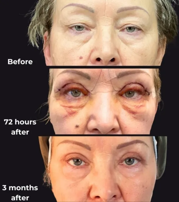 Eyelid Lift Guide: What to Know About Blepharoplasty