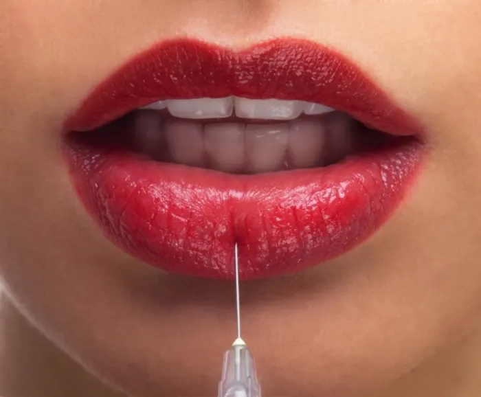 Lip Augmentation: Advanced Techniques for a Fuller Pout