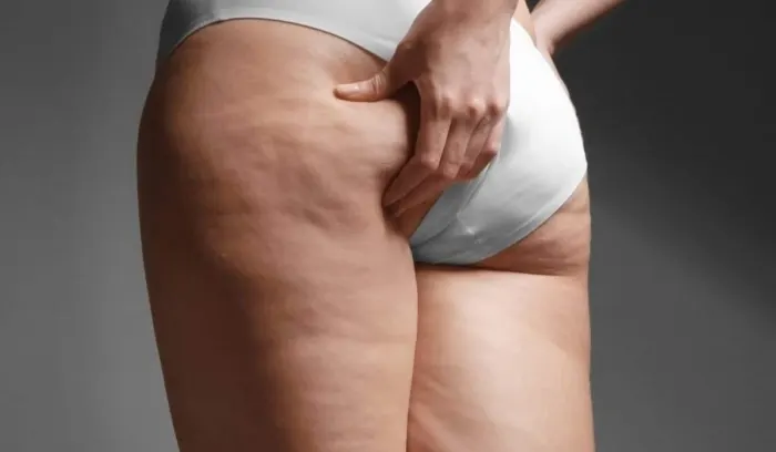 Cellulite: Causes & Treatment Options