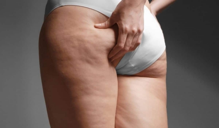 Cellulite: Causes & Treatment Options