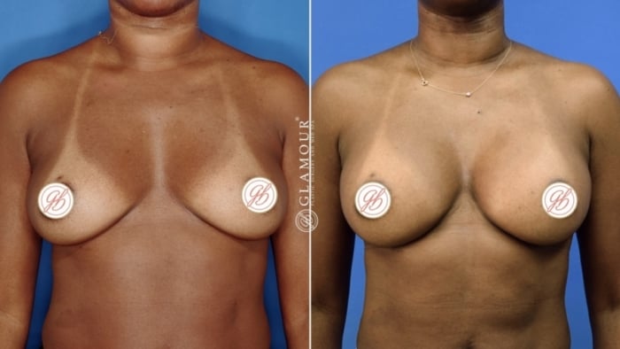 motiva breast implants price in Houston TX
