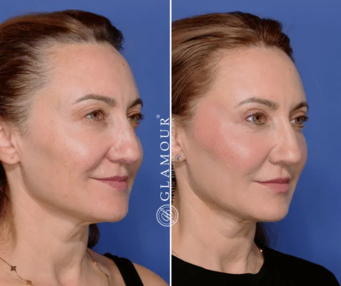 Upper Blepharoplasty with Dr. Bachilo: Minimal Downtime