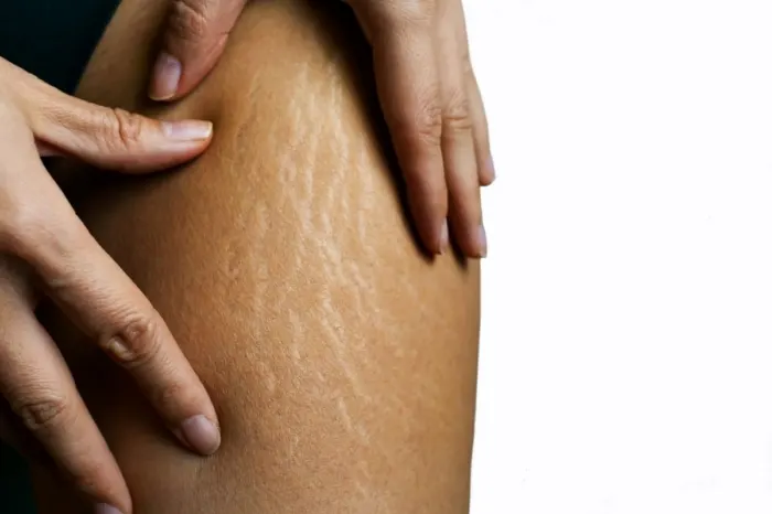 Stretch Marks: Causes, Types, Prevention & Treatments