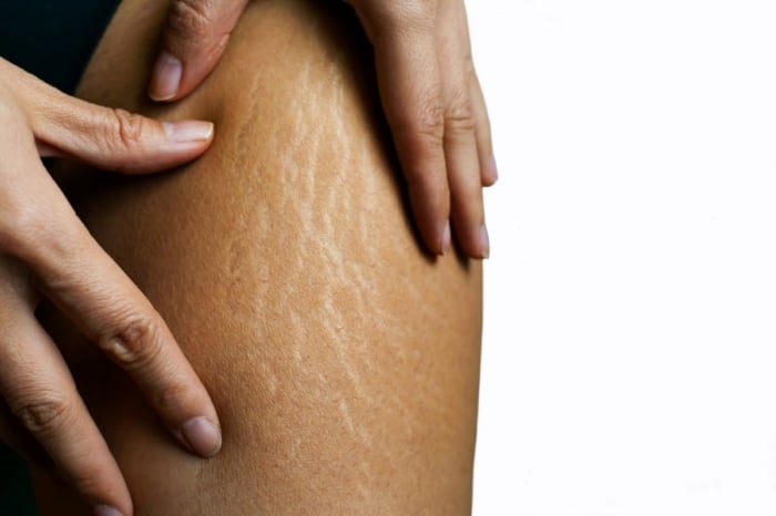 Stretch Marks: Causes, Types, Prevention & Treatments