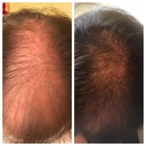 PRP Injections for Hair Loss: How They Work
